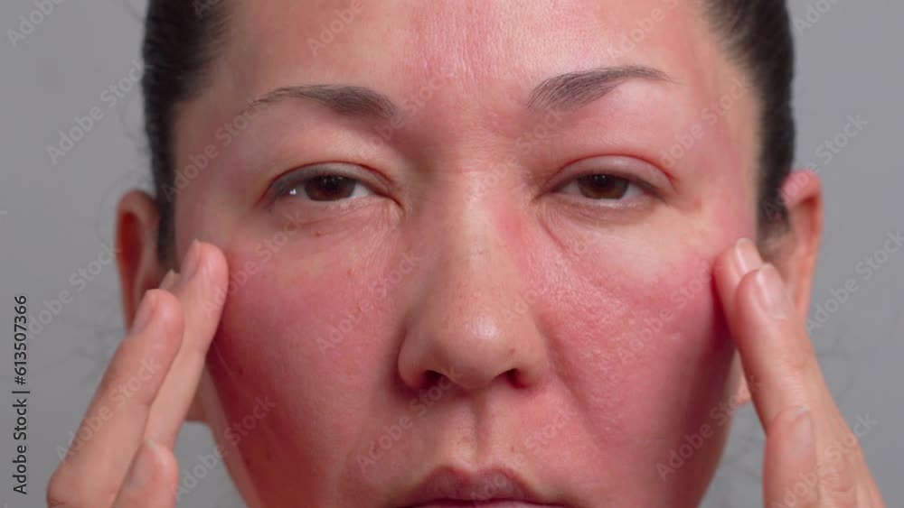 allergies, rosacea, rosacea, redness of the skin, red spots on the