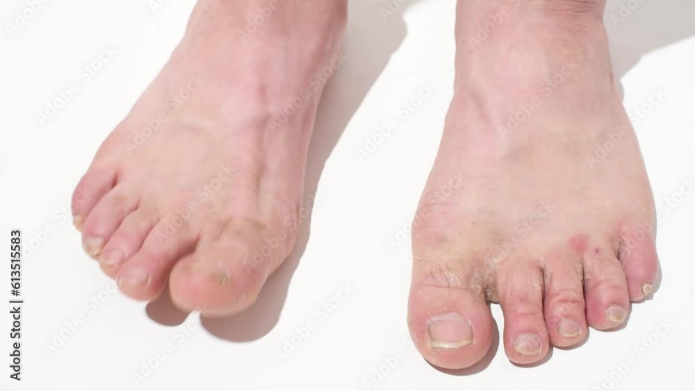 Top view man's feet and nails affected by fungus. Legs on white background horizontal 4k footage. Beauty concept . Treatment of fungus and red rashes on the legs Top view man's feet and nails affected by fungus. Legs on white background horizontal 4k footage. Beauty concept . Treatment of fungus and red rashes on the legs