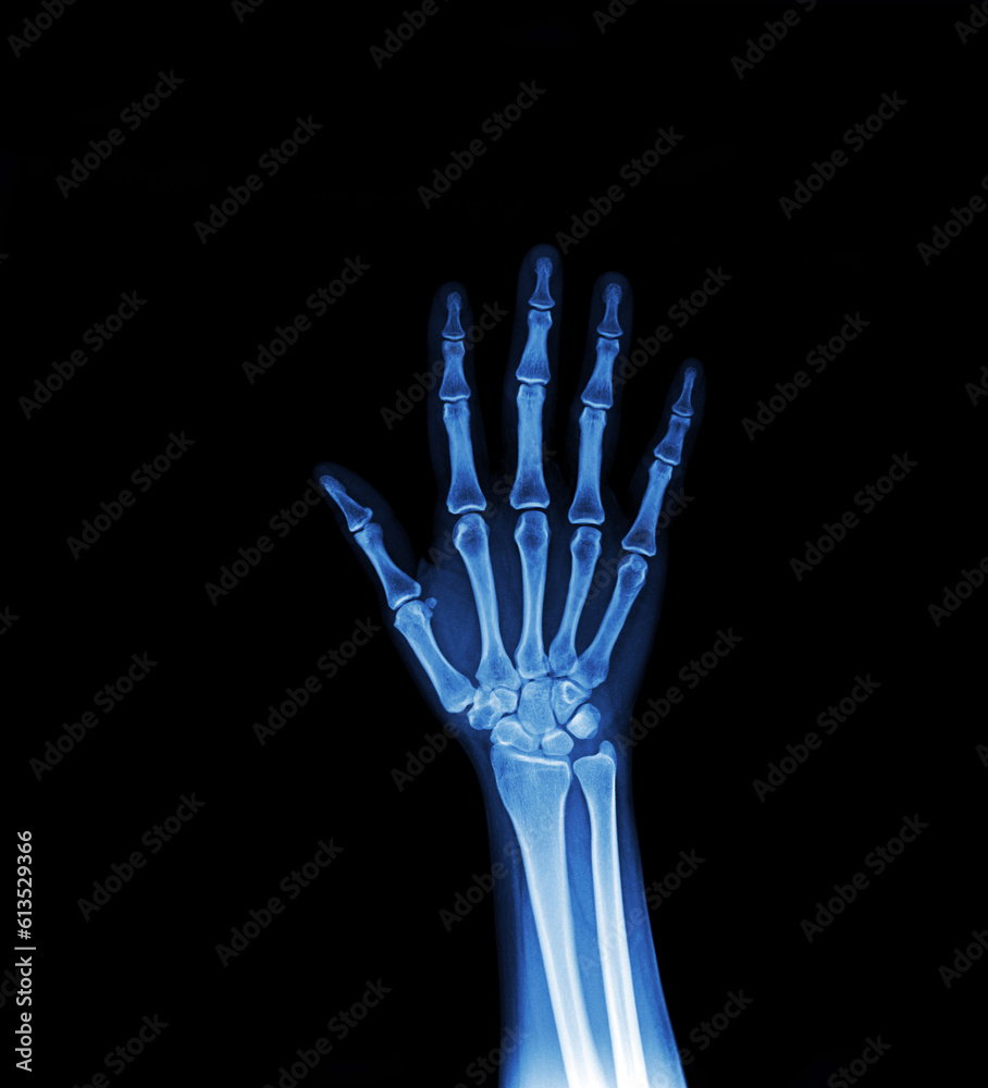 x ray of hand x ray of hand