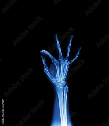 x ray of human hand