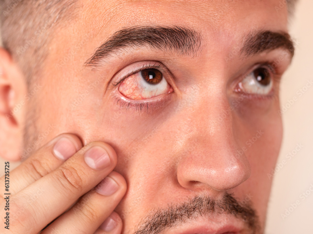 Obraz premium Man shows irritated red bloody eye