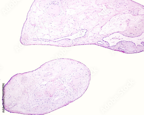 Hydatidiform mole photo