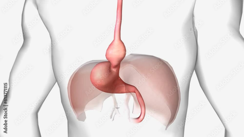A hiatal hernia occurs when the upper part of your stomach bulges through the large muscle separating your abdomen and chest . A hiatal hernia occurs when the upper part of your stomach bulges through the large muscle separating your abdomen and chest .