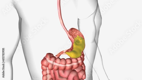Gastric outlet obstruction (GOO) is a result of any disease process that causes a mechanical impediment to gastric emptying
