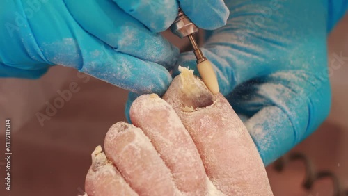 The work of a podiatrist is caring for toenails in an elderly person. nail disease. Hyperkeratosis and keratinized skin, close-up. Slow motion photo