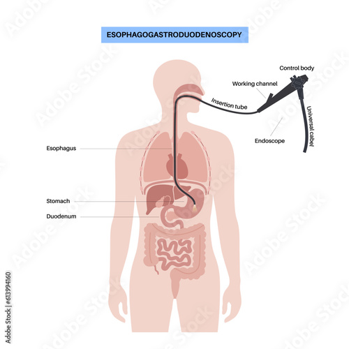 Gastroscopy endoscopy procedure