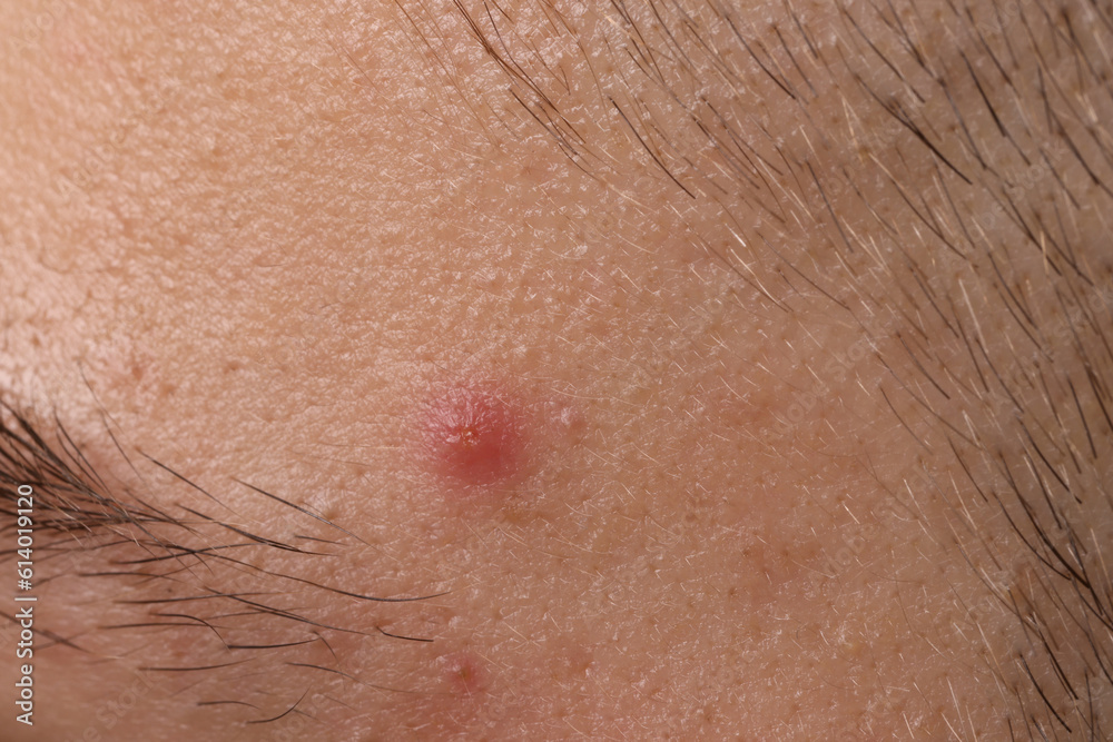 Young man with acne problem, closeup view Young man with acne problem, closeup view