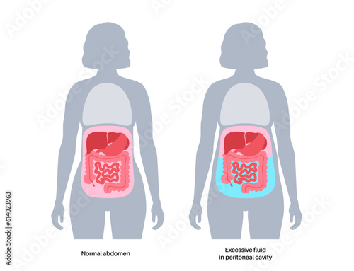 Ascites disease poster