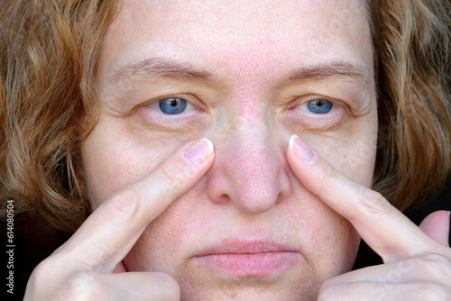 middle aged female's eye with drooping eyelid with patch for eyes. Ptosis is a drooping of the upper eyelid, lazy eye. Cosmetology and facial concept, first wrinkles