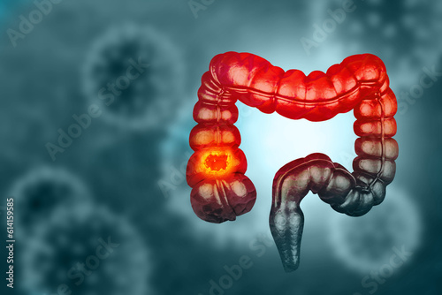 Colon cancer. Cancer attacking cell. Colon disease concept. 3d illustration © Crystal light