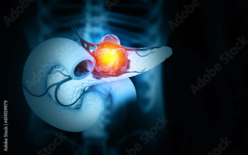 Pancreatic cancer is cancer that forms in the cells of the pancreas. 3d illustration photo