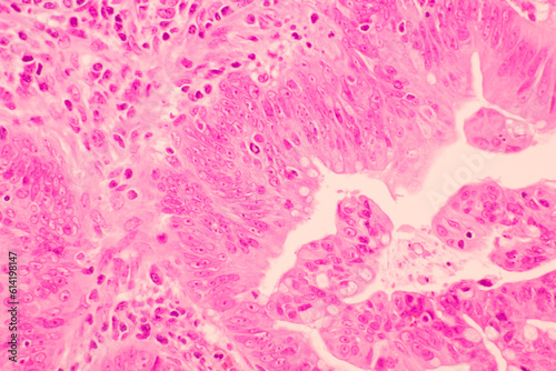 Backgrounds of human cells tissue of lung human under the microscope in pathology lab.View in microscopic of ductal cell carcinoma, adenonocarcinoma from human breast cancer, tissue section by H and E photo