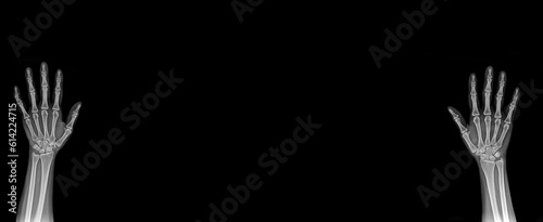 X-Ray Hands ( front view ) : Normal human hands