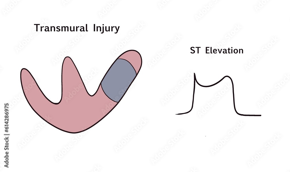 Transmural injury ischemic st segment and t wave changes stock