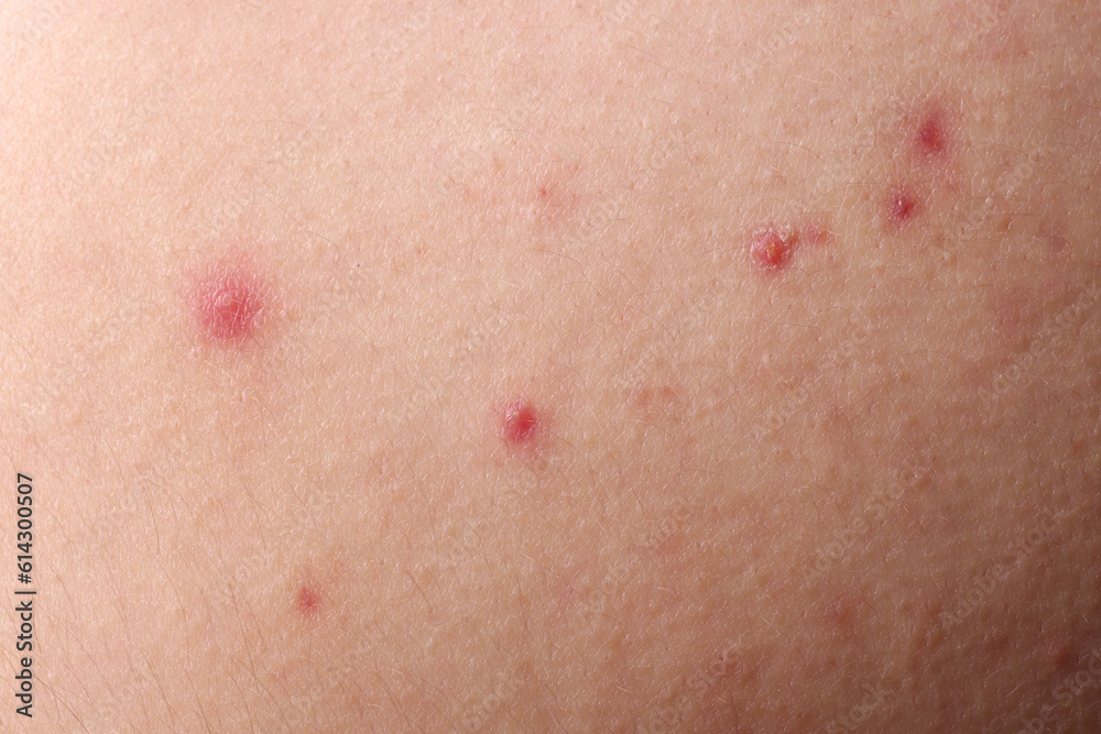 Young person with acne problem, closeup view of skin