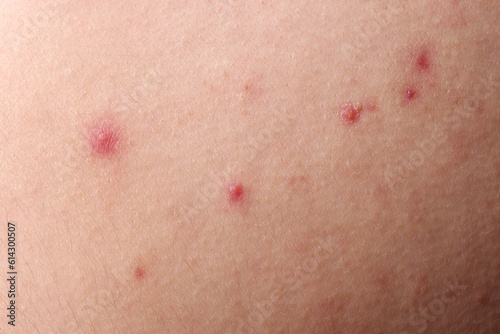Young person with acne problem, closeup view of skin