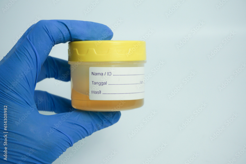 Hand holding urine sample container for medical urinalysis. Urine