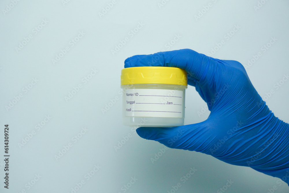 Hand holding urine sample container for medical urinalysis. Urine analysis in the laboratory. Medical urine tests. Urine sample for laboratory analysis. Hand holding urine sample container for medical urinalysis. Urine analysis in the laboratory. Medical urine tests. Urine sample for laboratory analysis.