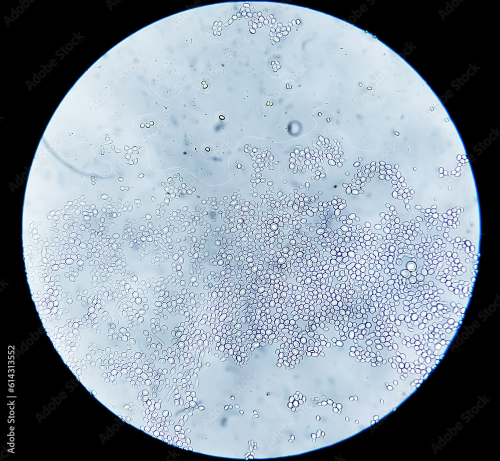 Budding yeast cells in patient urine (urinary tract infections