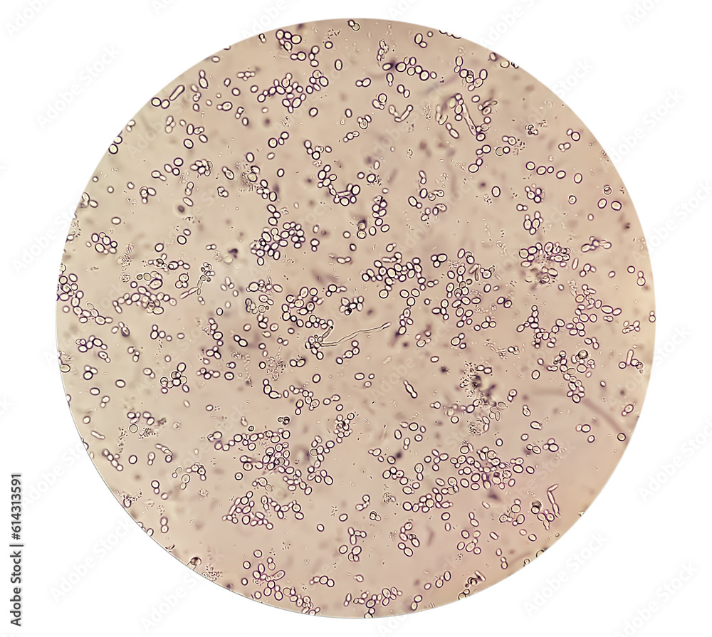 Budding yeast cells in patient urine (urinary tract infections), pyelonephritis or cystitis, analyze by microscope. Budding yeast cells in patient urine (urinary tract infections), pyelonephritis or cystitis, analyze by microscope.