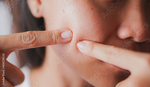 Young woman with acne problem squishing pimples on white background