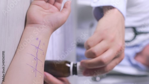 Verticar video of Allergist conducts a prik allergy test, Allergic reactions concept photo