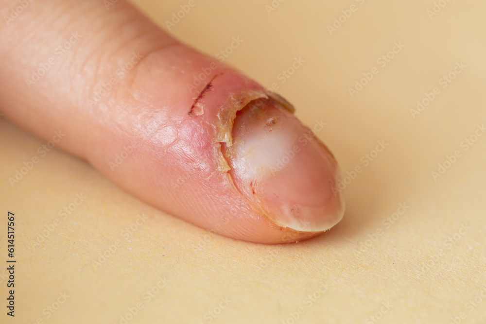 Inflammation of the finger. Managing Finger Inflammation.