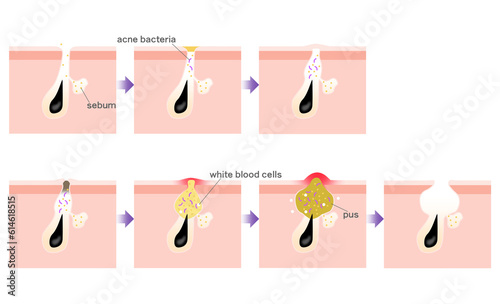 ニキビの進行がわかるシンプルな説明イラスト photo