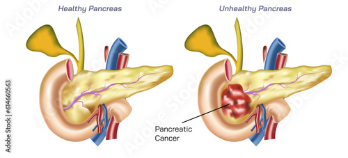 Realistic human pancreas diseases vector illustration. cystic fibrosis, annular pancreas, acute pancreatitis, enlarged pancreas, pancreas inflammation, anatomic abnormality. endocrine, exocrine. 