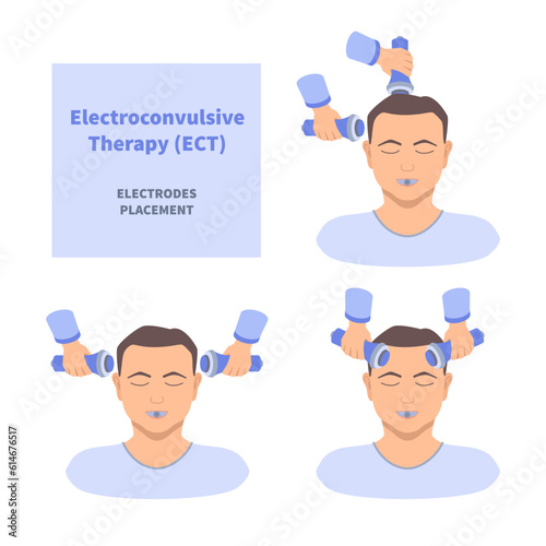Electroconvulsive therapy for severe depression and schizophrenia treatment. ECT electrodes placement. Brain stimulation equipment for bipolar, major depressive disorders. Vector medical illustration