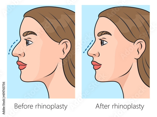 Correction of crooked nose with rhinoplasty schematic vector illustration. Medical science educational illustration