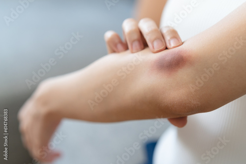 Foto Close-up purple bruised on the arm of human from accident.
