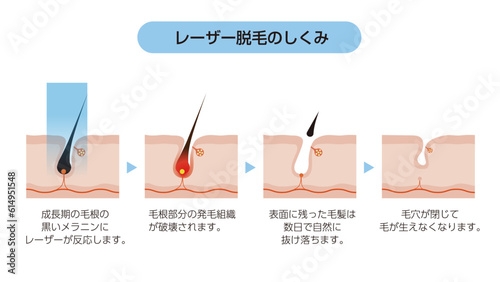 医療レーザー脱毛のしくみと毛周期