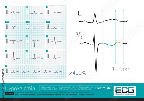 A 14-year-old boy with leukemia developed recurrent ventricular arrhythmias and electrolyte disturbances during hospitalization, and eventually died during hospitalization.