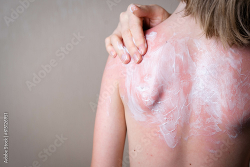 sunburn  red skin of the child s back  hand lubricates inflamed skin with a soothing cream  copy space