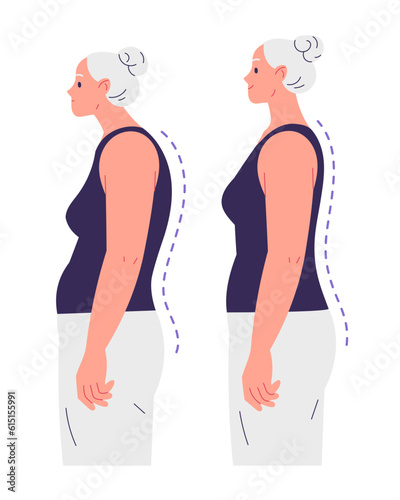 Elderly woman with impaired posture and correct posture