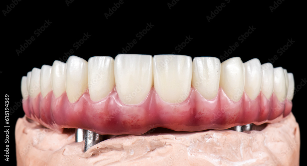 Emax ceramics on hybrid implant bridge Emax ceramics on hybrid implant bridge