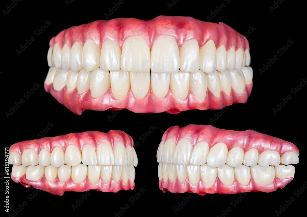 Emax ceramics on hybrid implant bridge Emax ceramics on hybrid implant bridge