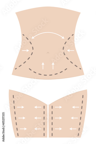 Slim fit woman body with surgical dotted lines before plastic surgery with underwear, arrows, marks on skin.
Concept Fat loss, liposuction, cellulite removal, skin lifting
Editable vector illustration