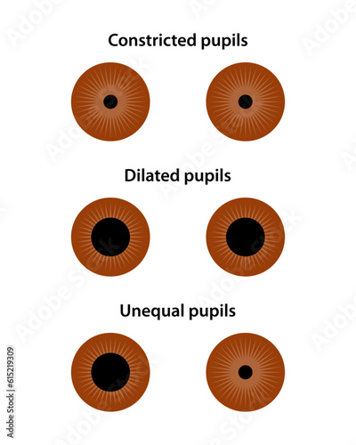 Human eye. Constricted, dilated, and unequal pupils.