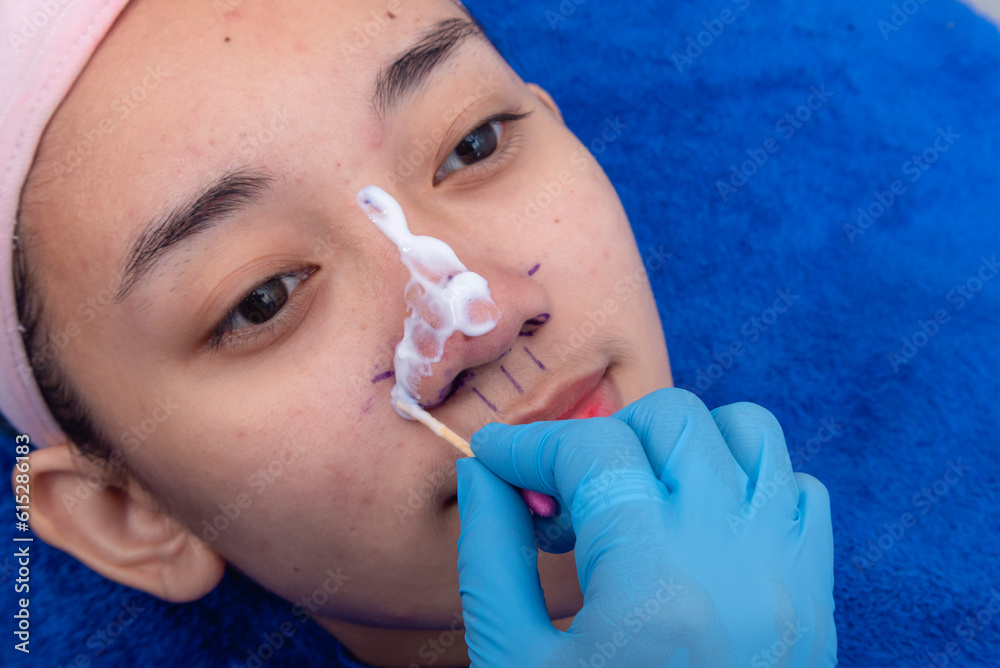 Applying topical anesthesia via a cotton swab to the nose to numb the