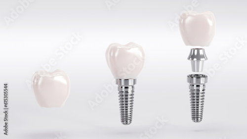 3d rendering of tooth and dental implant for stomatology set, Implants surgery concept