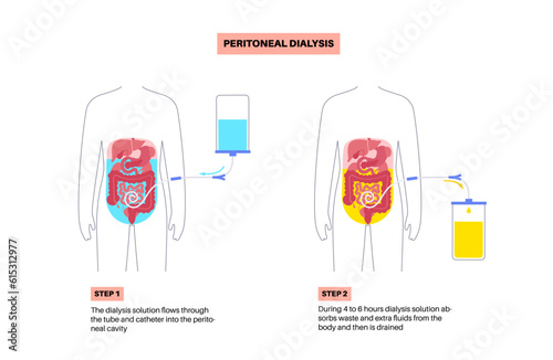 Peritoneal dialysis concept