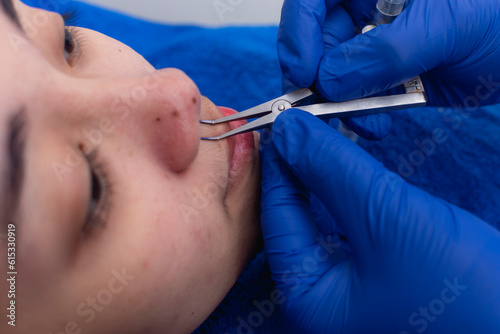 A cosmetic surgeon uses a dental gauge caliper to measure the columella of a patient's nose. Preoperative procedure before rhinoplasty. photo