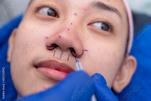 A cosmetic surgeon drawing lines on the alars of a pateint's nose before alarplasty and rhinoplasty procedures. Marking the portions of tissue to be cut off. photo