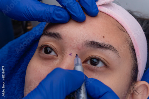 A cosmetic surgeon drawing lines on the bridge of a pateint's nose before rhinoplasty procedures. Marking the portions of tissue to be cut off. photo