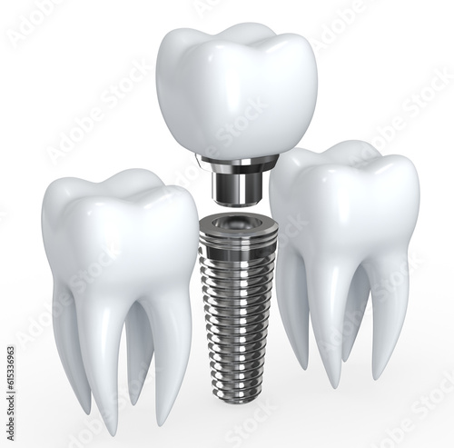 Картината върху платно white Tooth Implant
