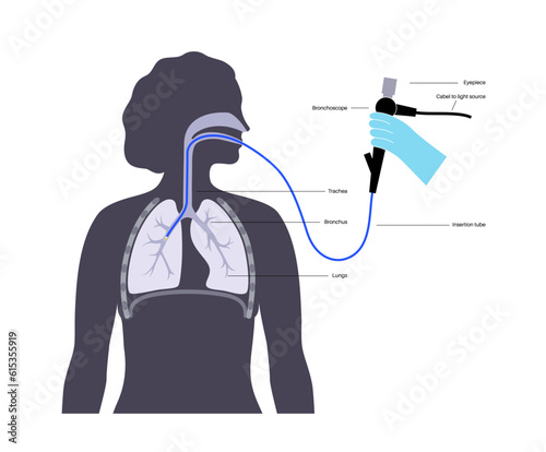 Bronchoscopy procedure concept