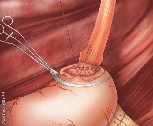 Gastroesophageal anastomosis surgery.This medical illustration shows the anastomosis technique of the remnant stomach and esophagus. photo