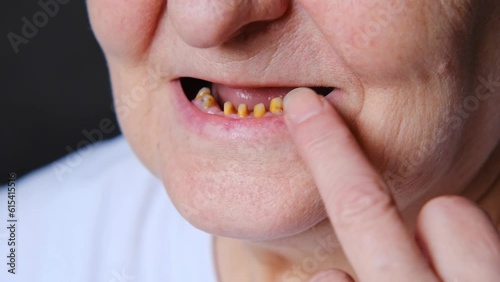 Toothless mouth with dental implants. Prosthetics, implantation of the dentition. An elderly woman shows yellow sharpened teeth for ceramic crowns. Orthodontic treatment photo